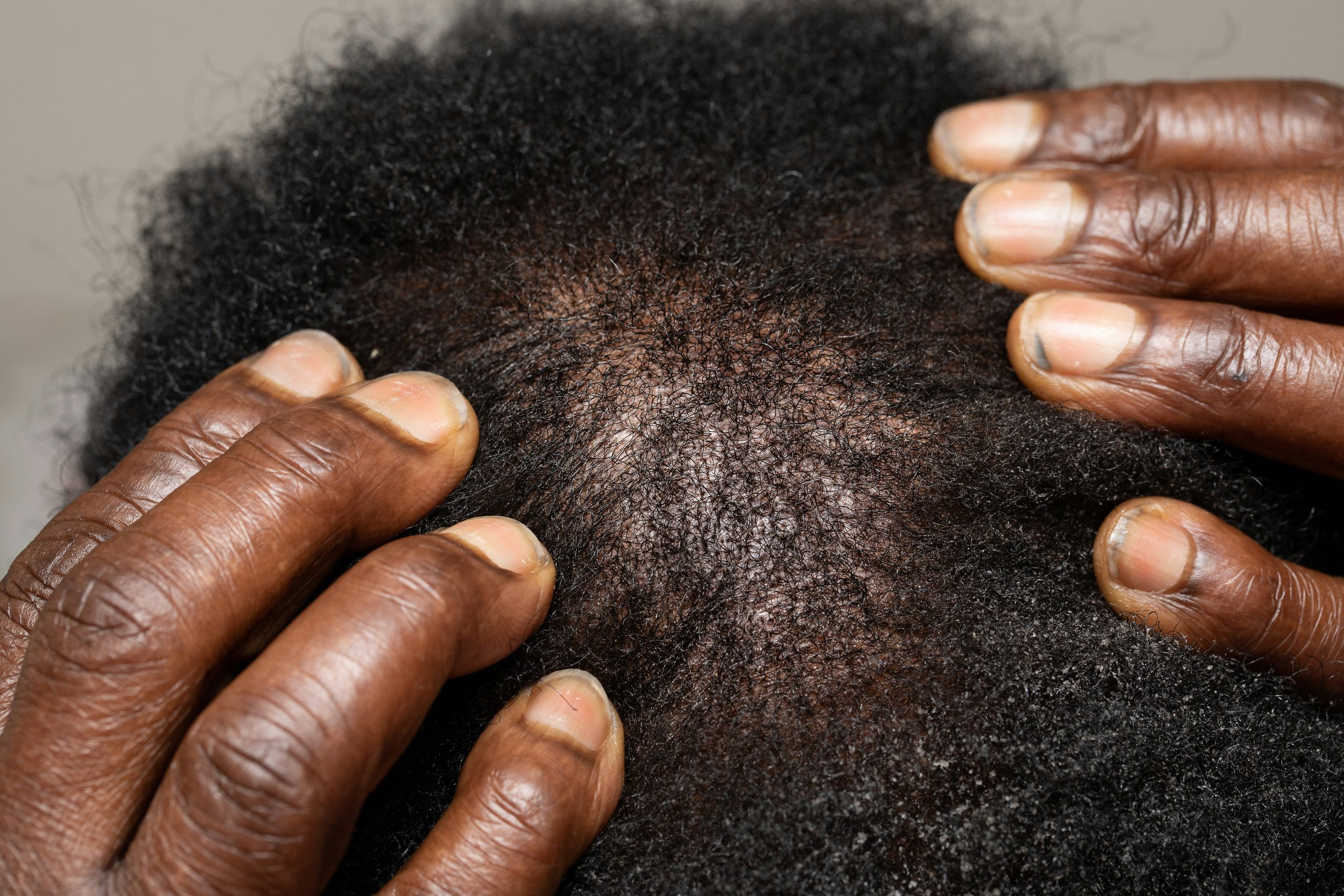 Male Pattern Baldness After 40: Why It Happens and What Actually Works